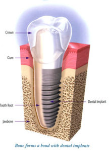 dental-implants