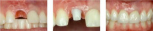 dental-implants1