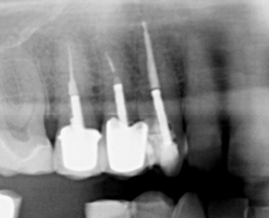 root-canal1