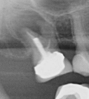 root-canal2