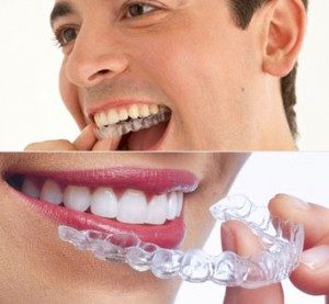 invisalign12