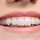 Tips for Looking After Your Braces