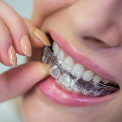 Invisalign
