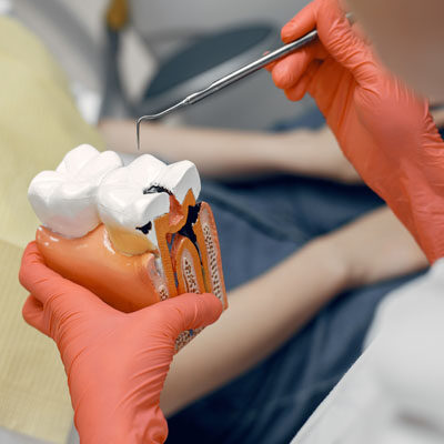 Root Canal Treatment