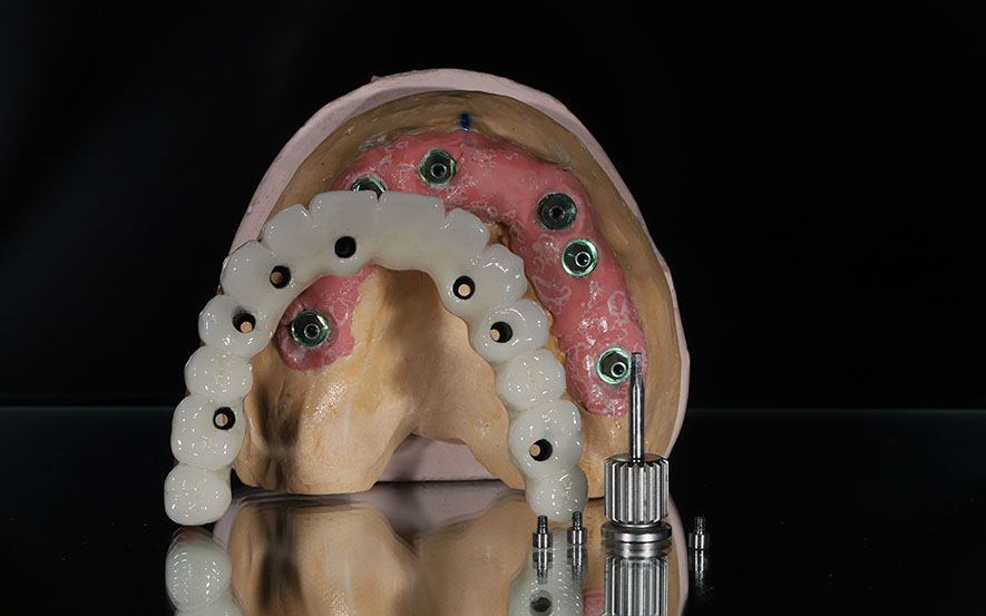 dental-bone-graft-img1
