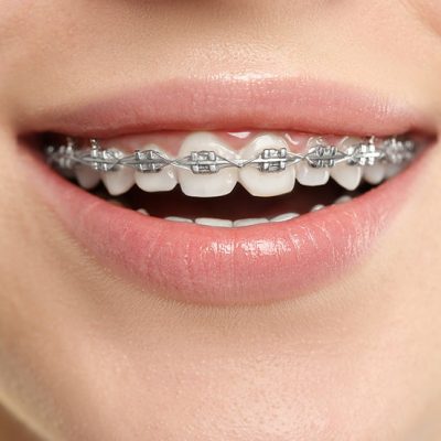 Braces