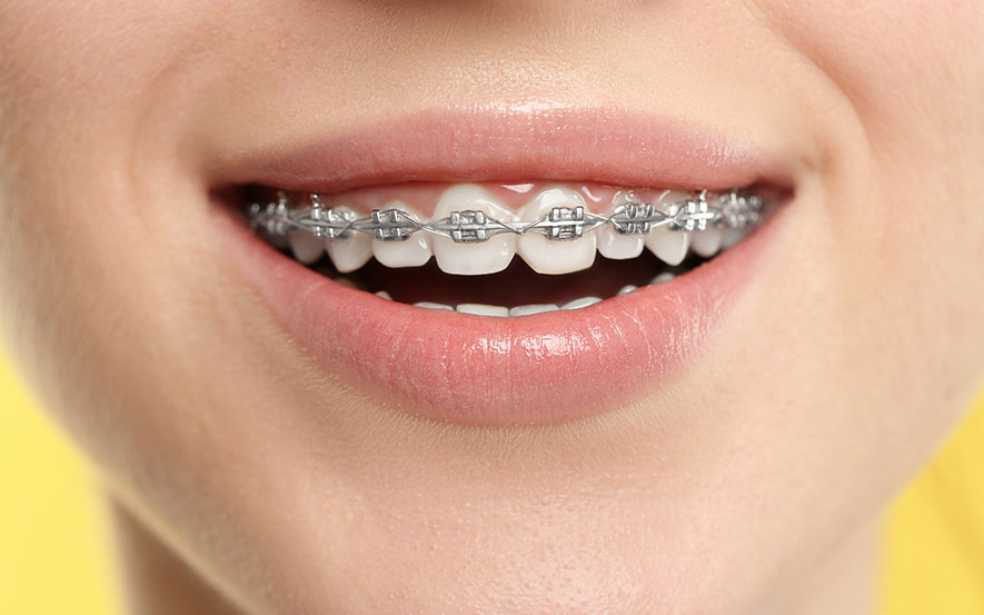 dental-braces-img21