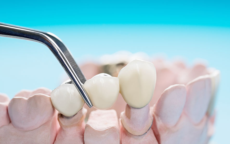 dental-bridges-img1