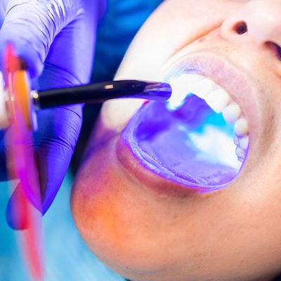Dental Fillings