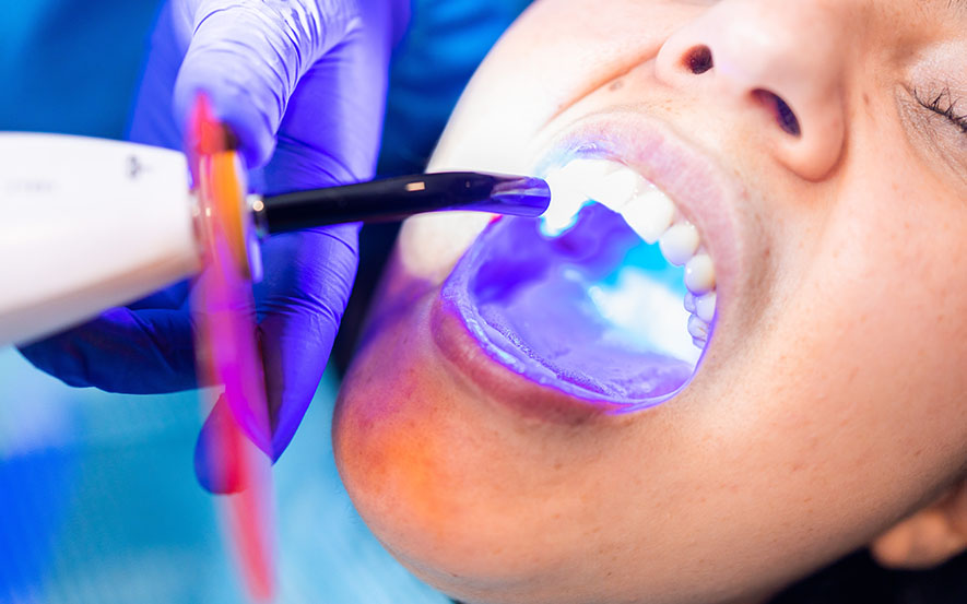 dental-fillings-image1