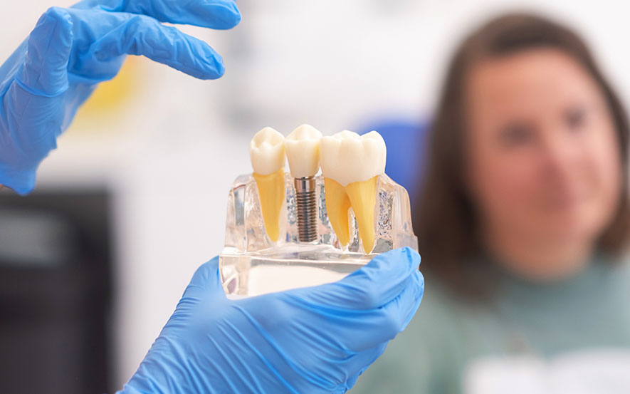 dental-implants-image2