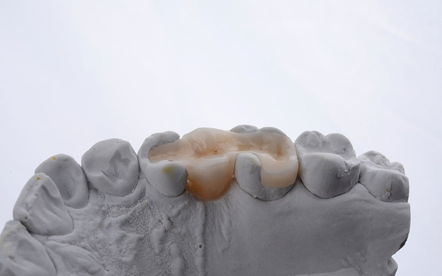 dental-inlays-and-onlays-img1