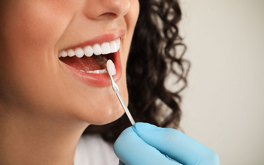 dental-veneers-image1