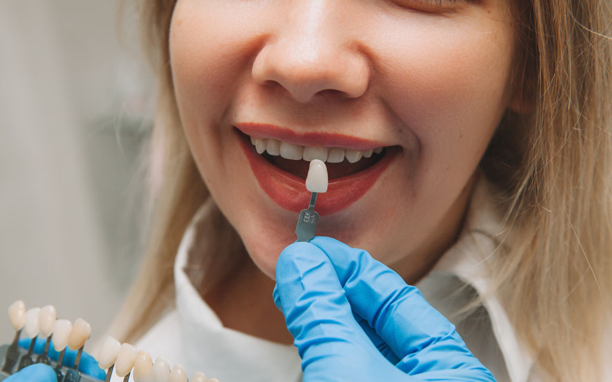 dental-veneers-image2