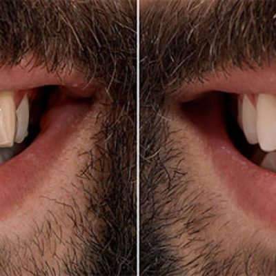 Smile Design