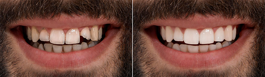 digital-smile-design-img1