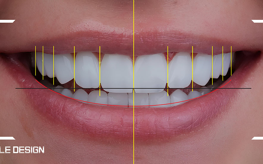 digital-smile-design-img2