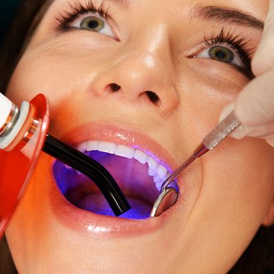 Fissure Sealant