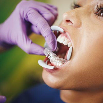 Retainers
