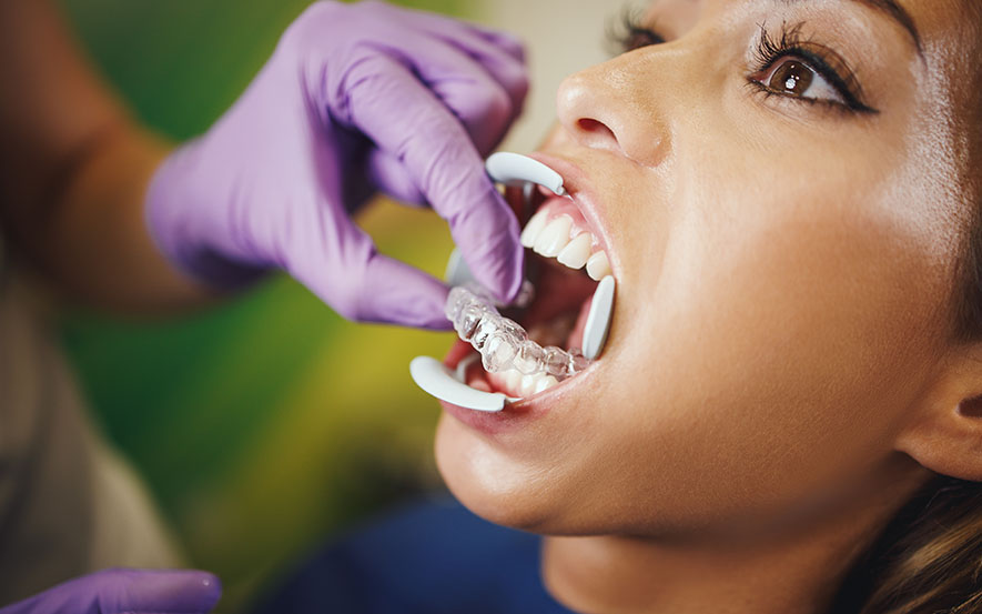 invisalign-img1