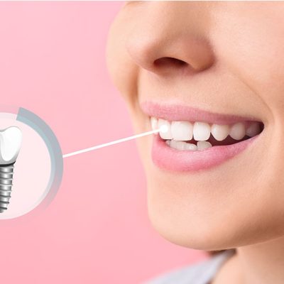 Single Missing Tooth