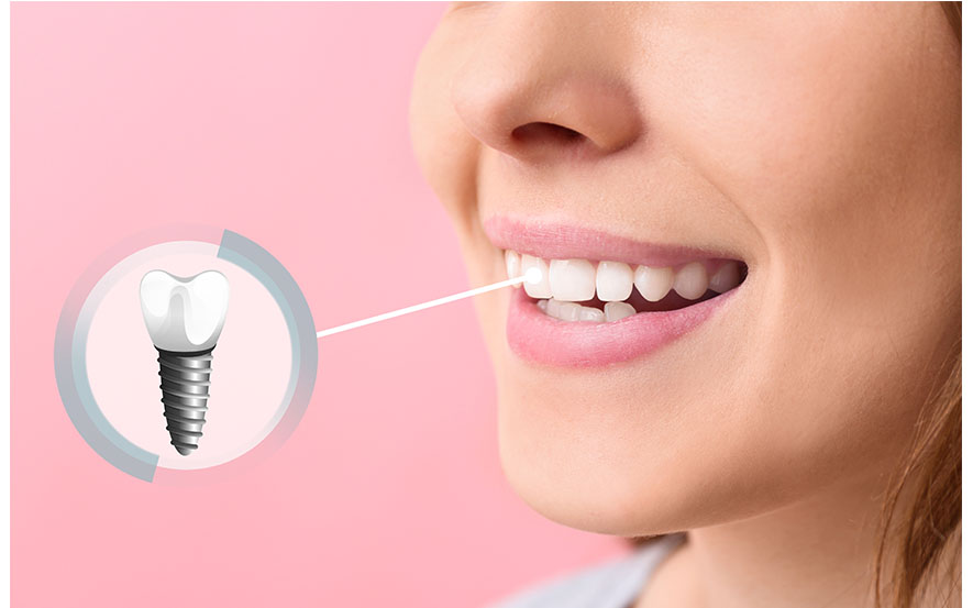one-tooth-implant-img1