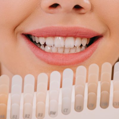 Porcelain Veneers