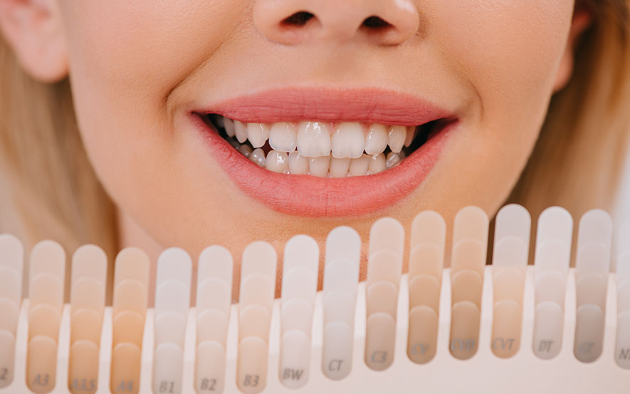 porcelain-veneers-image1