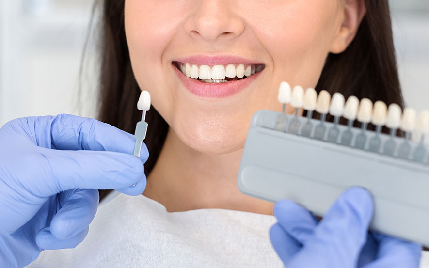 porcelain-veneers-image2