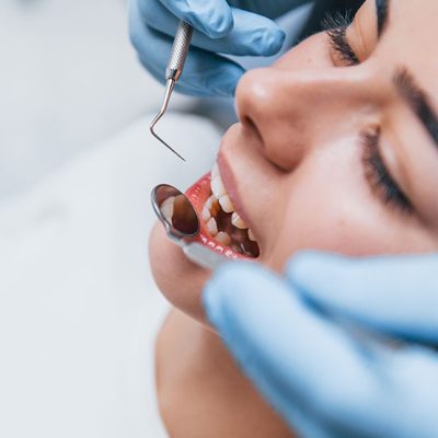 Composite Veneers