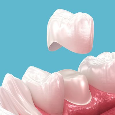 Teeth Whitening