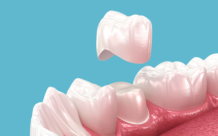 same-day-dental-crowns-image2