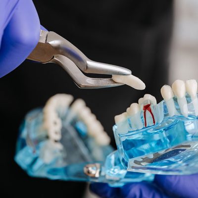 Surgical Extractions