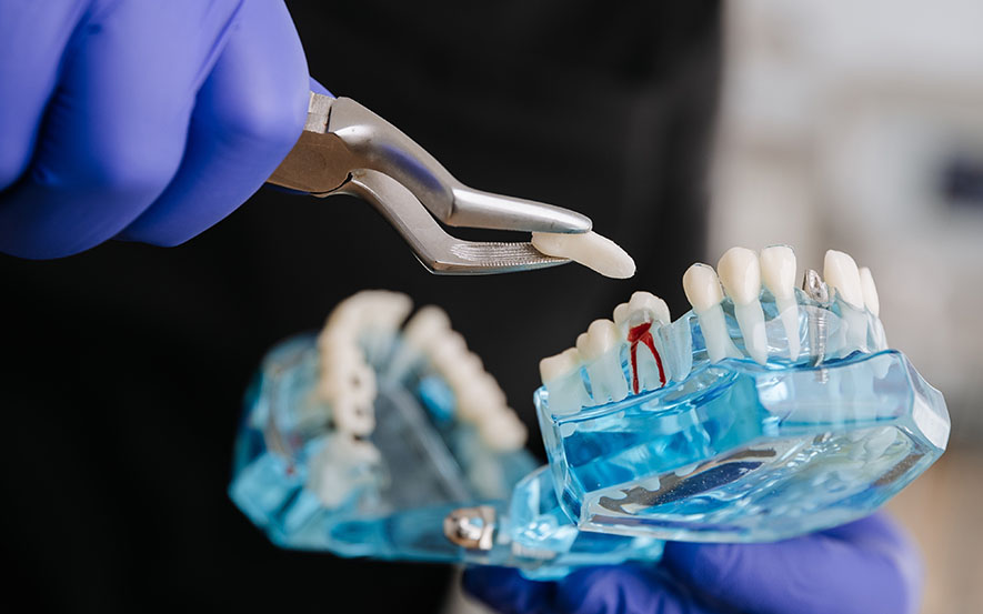 surgical-tooth-extraction-img2