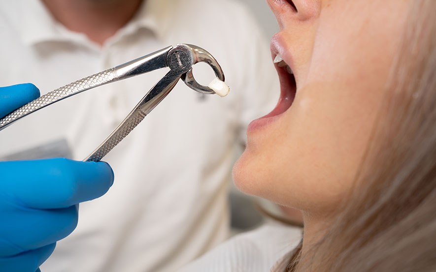 tooth-extraction-img1