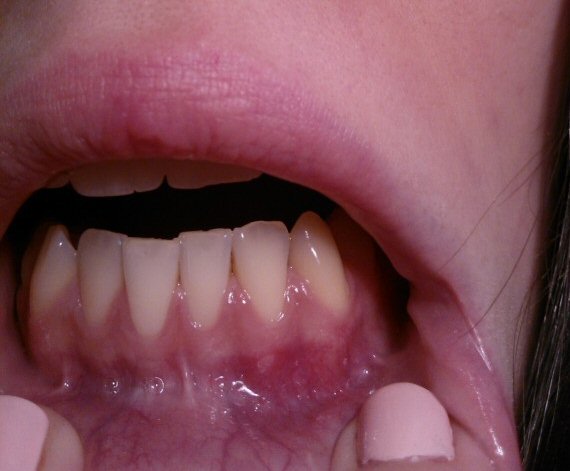 Signs You Might Need Dentures